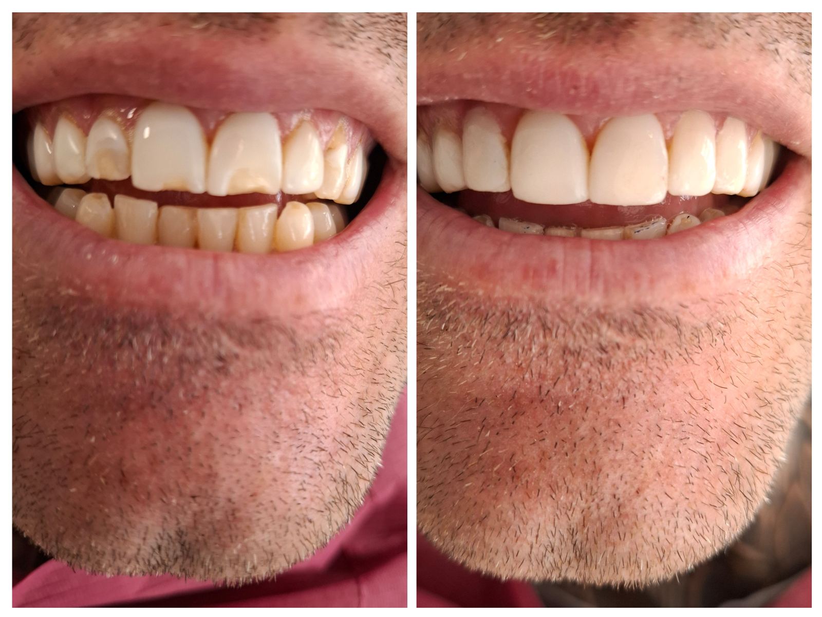 Επιδιόρθωση όψεων σύνθετης ρητίνης