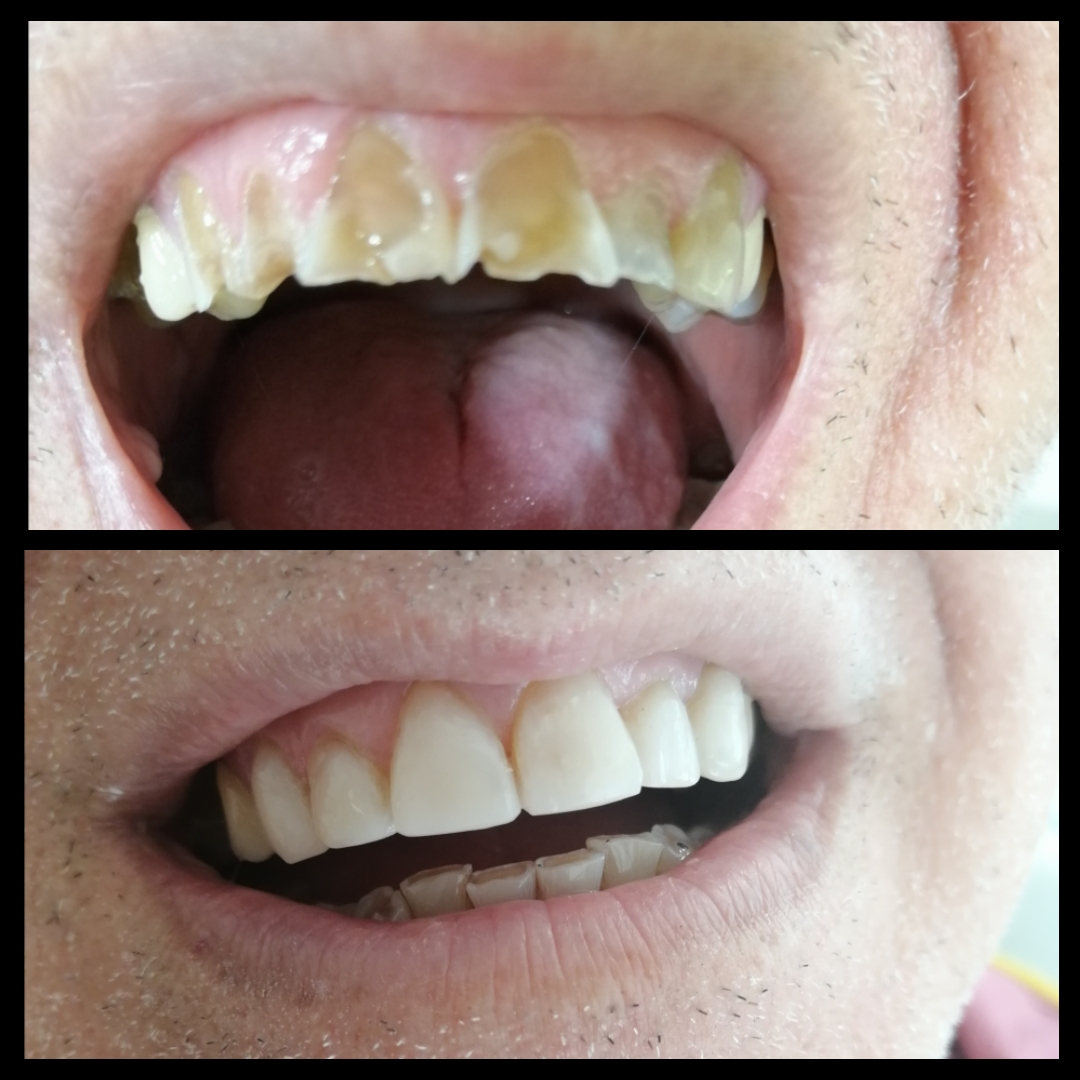 Αποκαταστάσεις διαβρωμένων δοντιών με σύνθετες ρητίνες