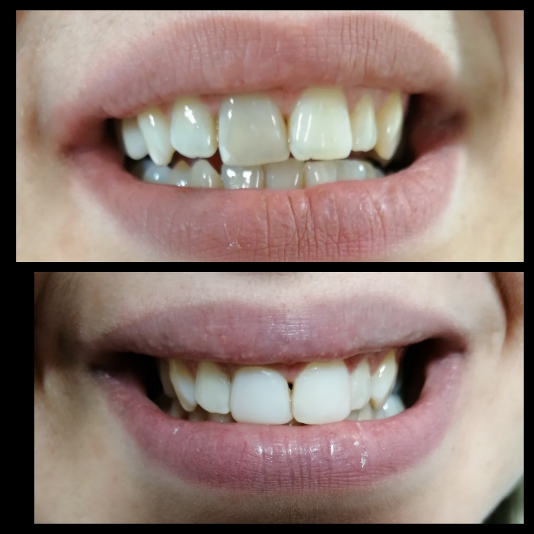 Βελτίωση χρώματος και σχήματος πρόσθιων δοντιών