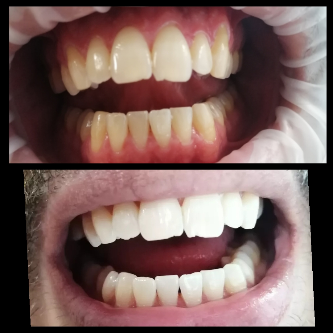 Λεύκανση ιατρείου