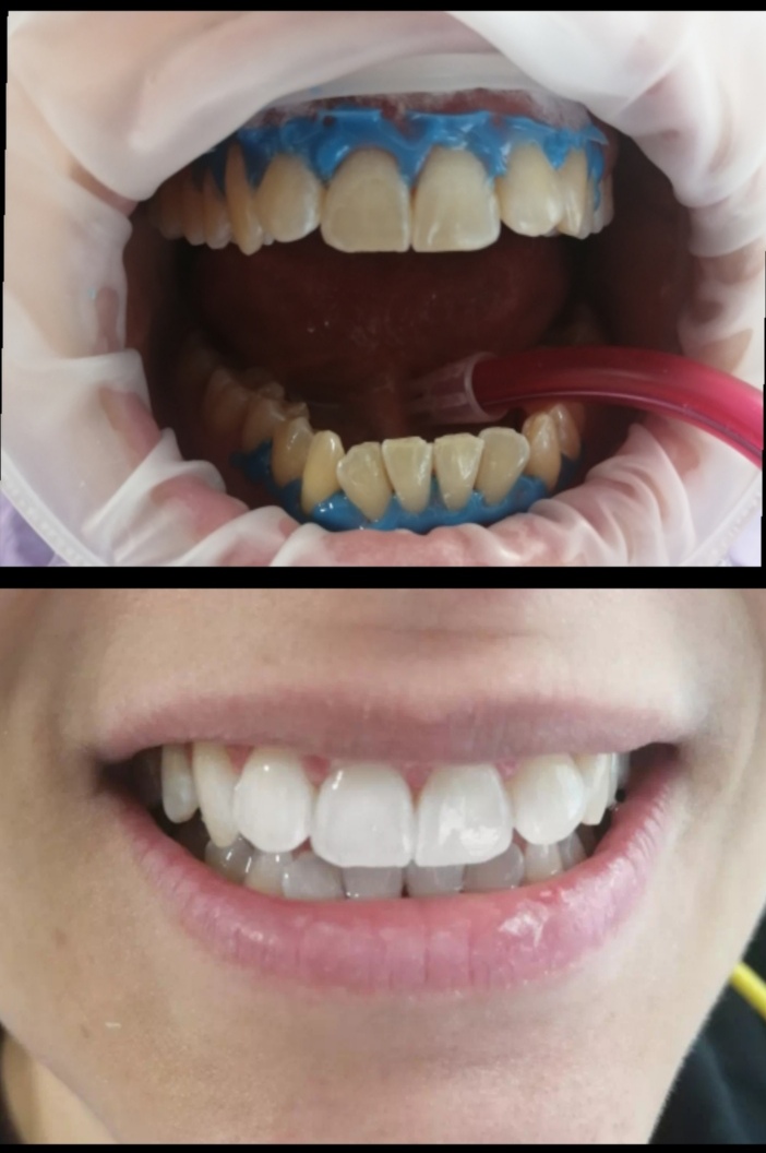 Λεύκανση ιατρείου